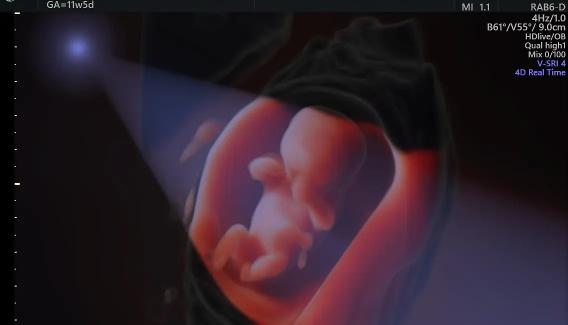 Fetal ECHO